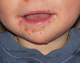 Chinese Health issues such as: Hand, Foot, and Mouth disease pictured - Click for more information